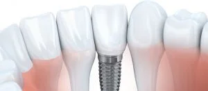 Implant