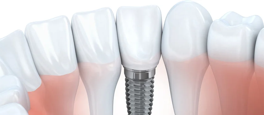 Implant Implant