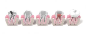 Root Canal