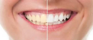 Teeth Whitening