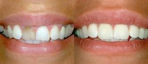 Cosmetic dentistry Sugar Land - Porcelain Veneers